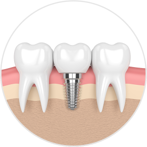 Dental Implants Illustation